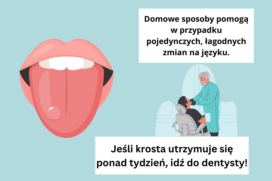 Domowe sposoby pomogą w przypadku pojedynczych, łagodnych zmian na języku. Jeśli krosta utrzymuje się ponad tydzień, idź do dentysty!