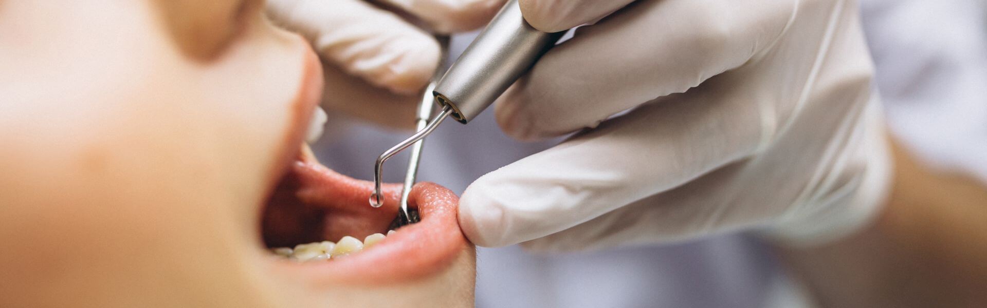 implanty zębowe cała szczęka cena