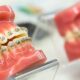 miniimplant ortodontyczny