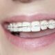 retainer