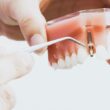 tymczasowa proteza na jednego zęba