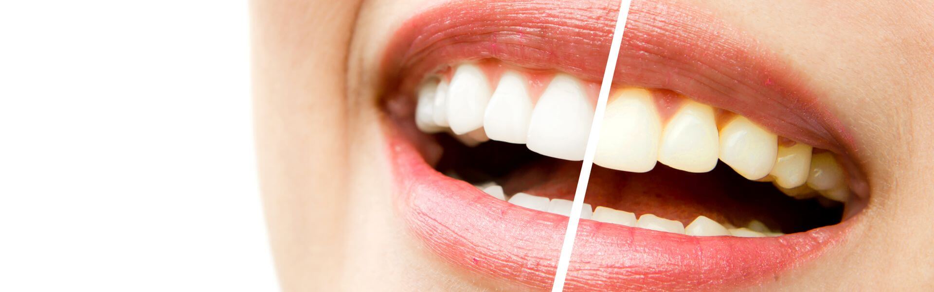 wybielanie zębów przed i po