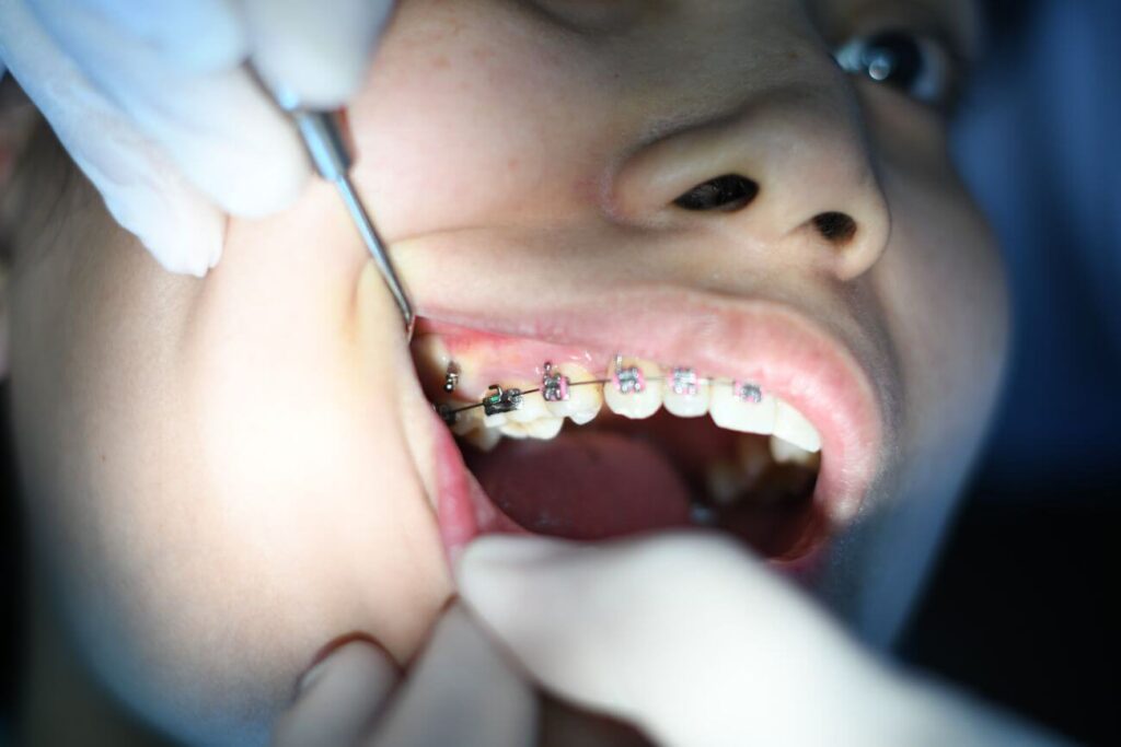 dofinansowanie do aparatu ortodontycznego dokręcanie aparatu