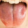 erytroplakia jamy ustnej