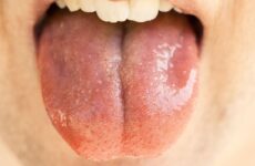 erytroplakia jamy ustnej