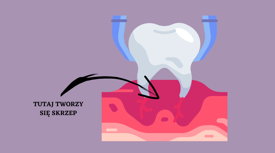 gdzie tworzy się skrzep po wyrwaniu zęba