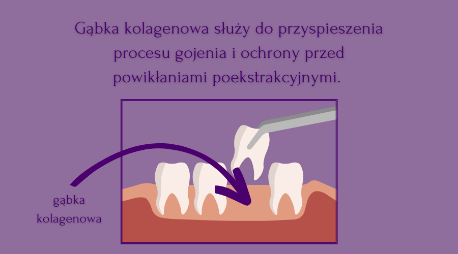 do czego służy gąbka kolagenowa po wyrwaniu zęba