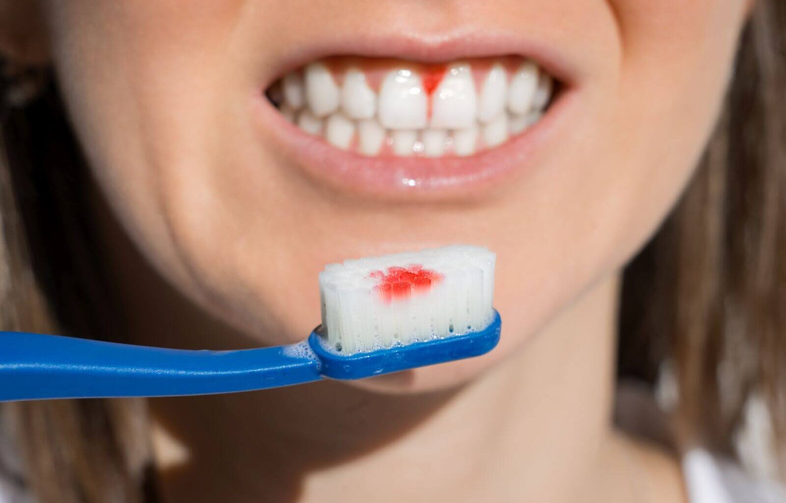 Krwawienie po wyrwaniu zęba