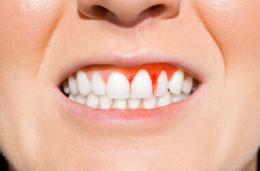 Krwotok po wyrwaniu zęba