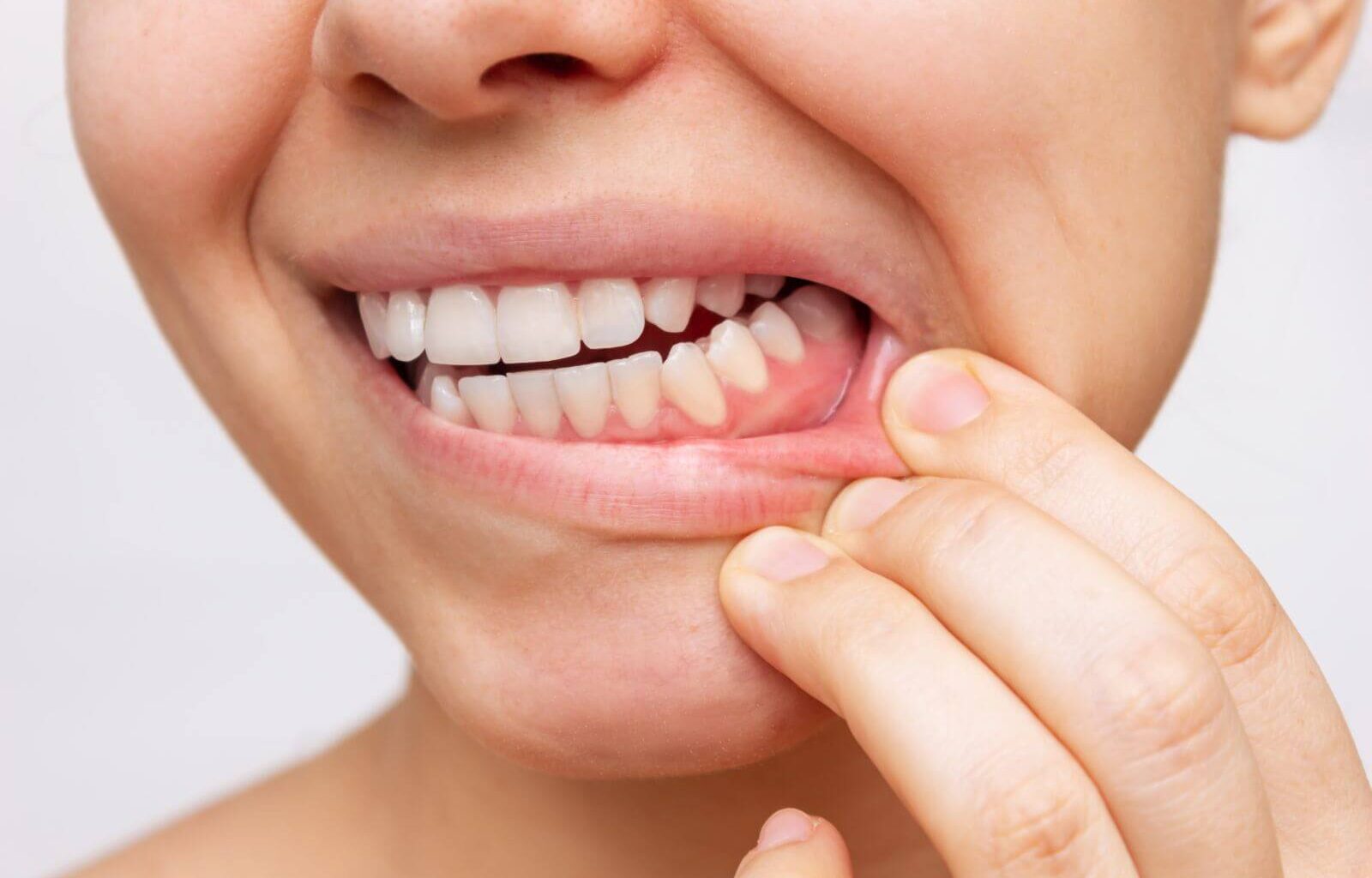 resztki zęba w dziąśle po wyrwaniu