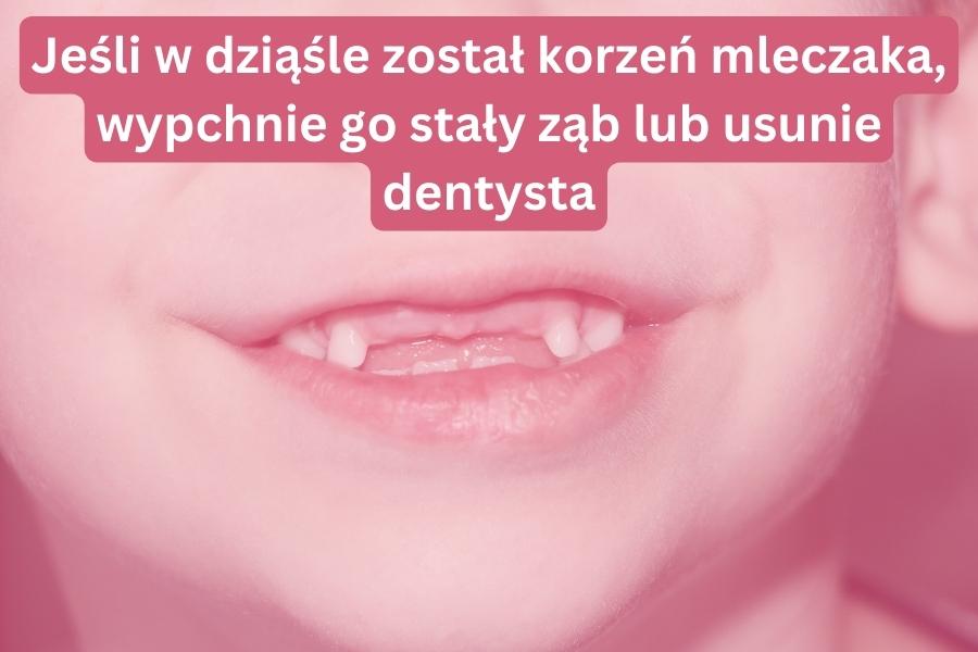 Jeśli w dziąśle został korzeń mleczaka, wypchnie go stały ząb lub usunie dentysta.