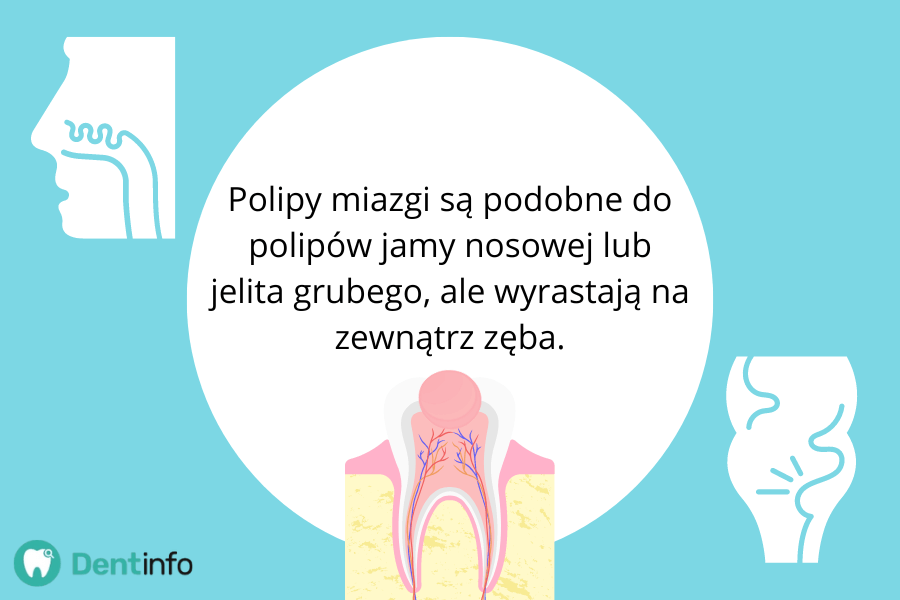 Polipy miazgi są podobne do polipów jamy nosowej lub jelita grubego, ale wyrastają na zewnątrz zęba.