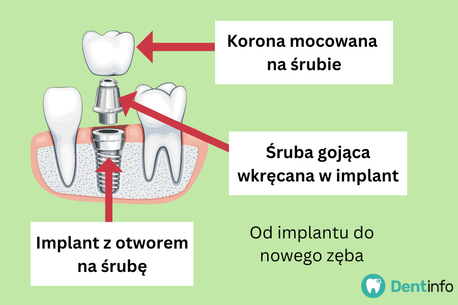 Od implantu do nowego zęba:
1. Implant z otworem na śrubę
2. Śruba gojąca wkręcana w implant
3. Korona mocowana na śrubie.