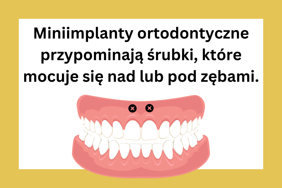 Miniimplanty ortodontyczne przypominają śrubki, które mocuje się nad lub pod zębami.